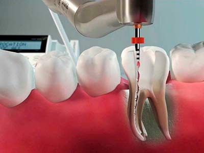 Endodontia-2