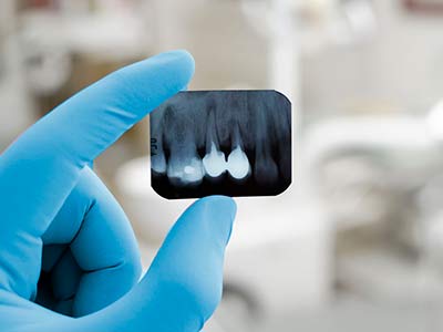 endodontia-5