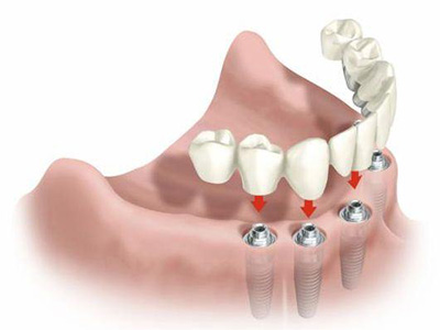 implantes-5