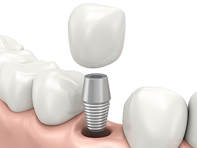 implantes-6