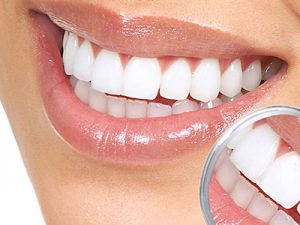 lentes-de-contato-dental2