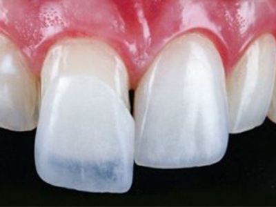 lentes-de-contato-dental3