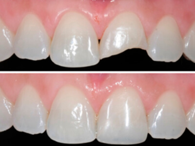 restauracoes-esteticas-dentarias RESTAURAÇÕES ESTÉTICAS DENTÁRIAS